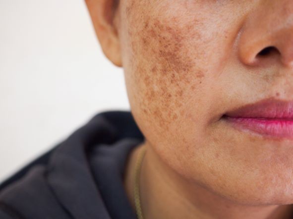 What Is Hyperpigmentation: Causes, Types, Symptoms and Treatments