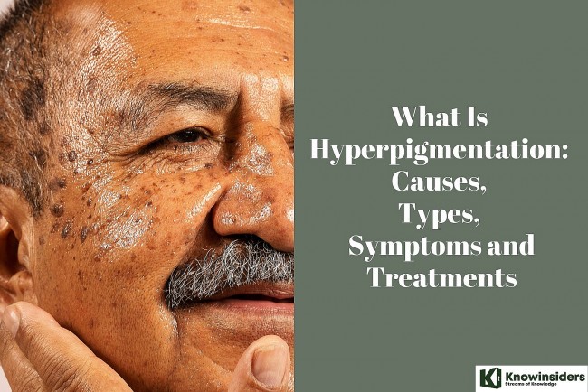 What Is Hyperpigmentation: Causes, Types, Symptoms and Treatments