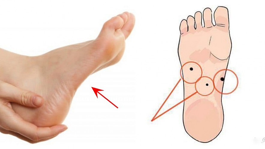 Moles on the soles of the feet