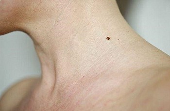 Physiognomy: Mole Location Reveals Women
