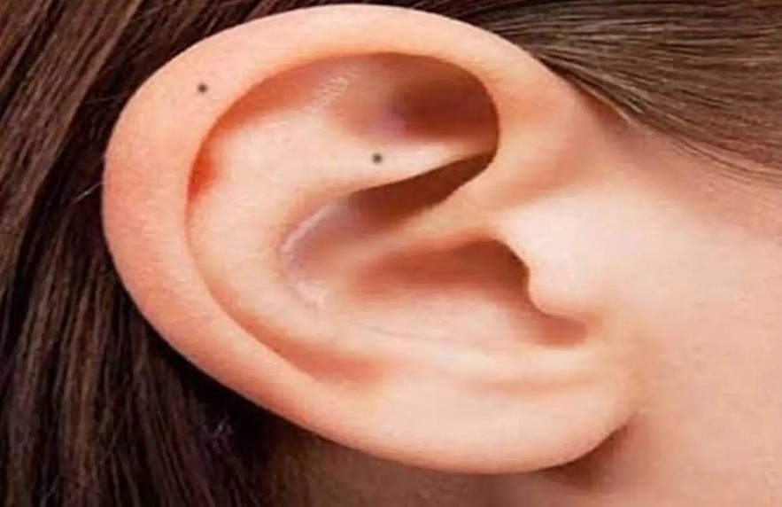 Physiognomy: 6 Moles on Ear Reveal Your Life Destiny
