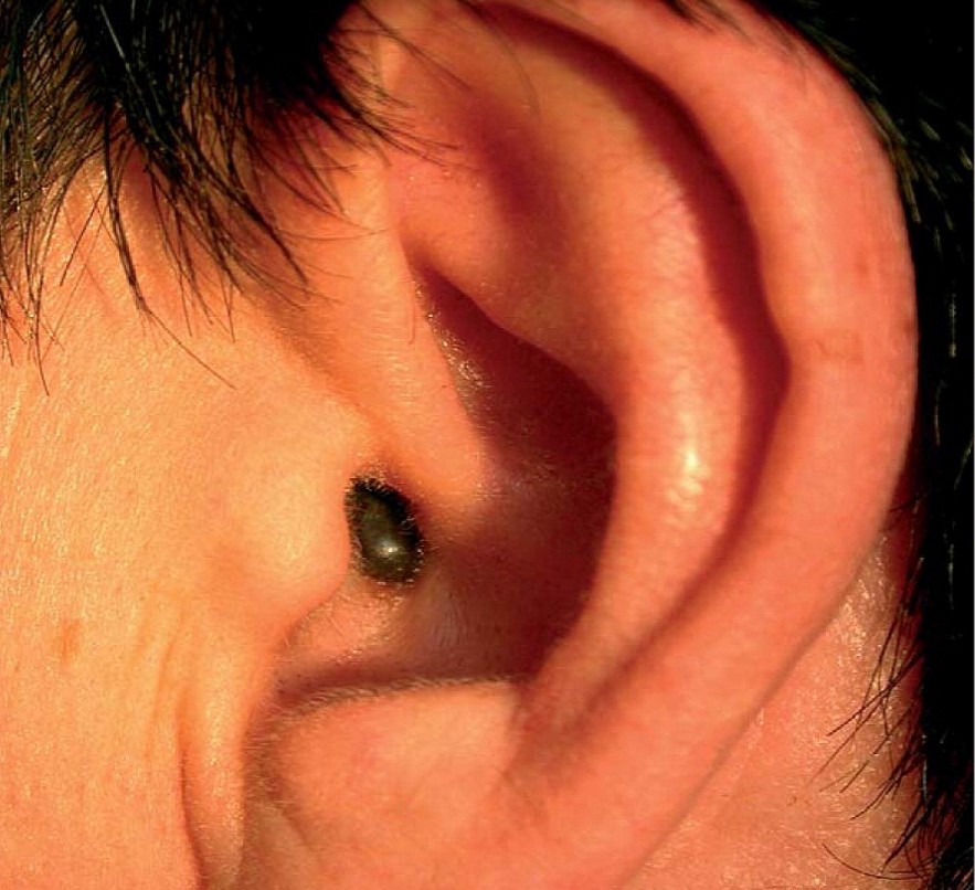 Six Moles on Ear Worth More Than Gold. How to Decode Their Meaning?