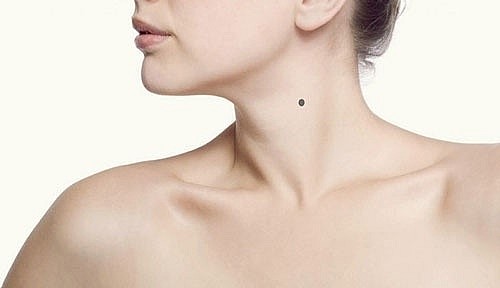 Moles are black or brown spots that form on the skin due to the concentration of substances that cause pigmentation.