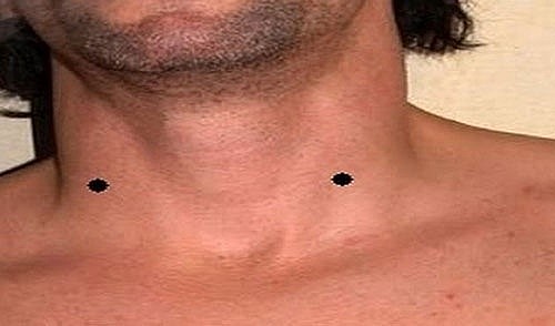 Seven Moles on the Neck Indicate Good Luck and A Wealthy Lifetime