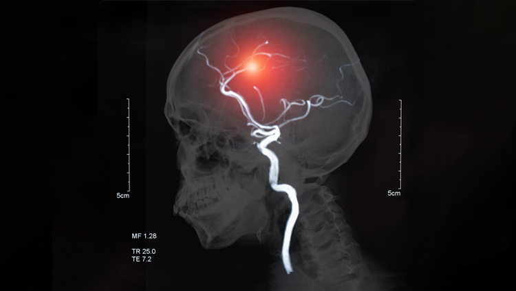 What is Stroke: Symptoms and Best Treatments
