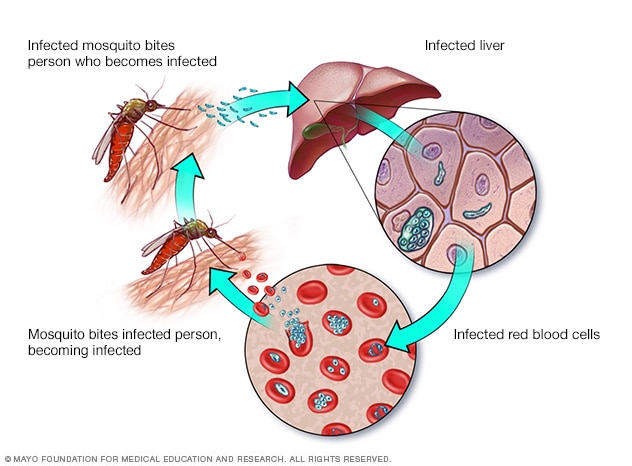Malaria - Symptoms and causes - Mayo Clinic