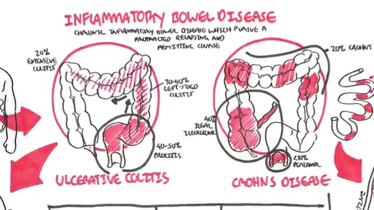 Colon Infection: Causes, Symptoms and Treatment