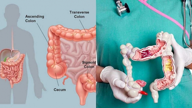 Colon Infection: Causes, Symptoms and Treatment