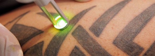 How to Remove Tattoos: Top 10 Best Ways
