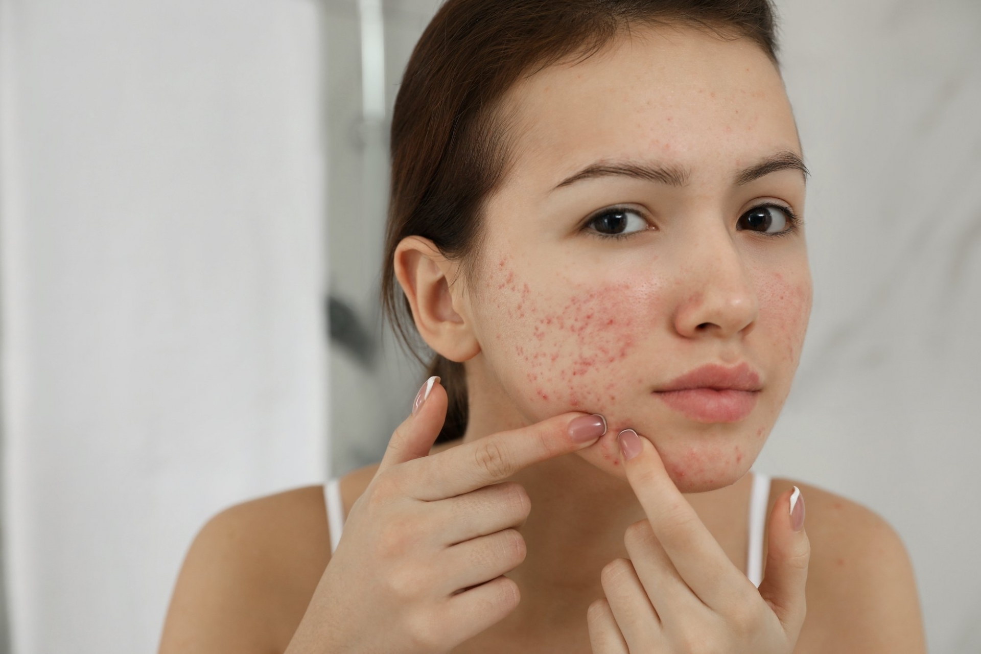 How To Remove Acne Scars With The Natural & Medical Treatments