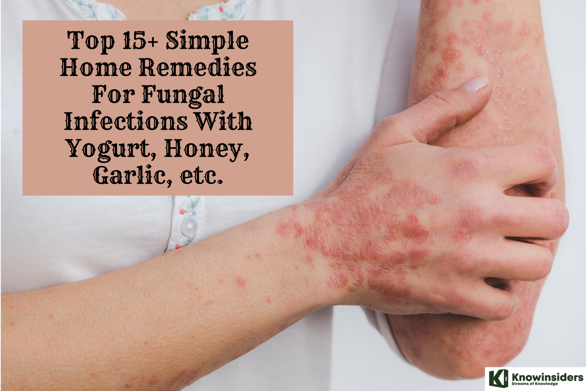 15 simple home remedies for fungal infections with yogurt honey garlic etc