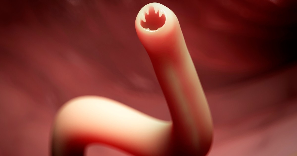 Hookworm in Humans & FAQs: Most Asked Questions with Answers about Hookworm
