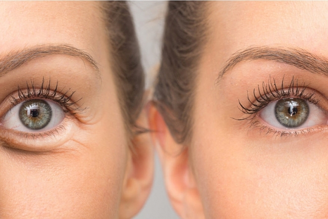 How to Get Rid of Bags Under Eyes: At-Home Remedies or Therapies?
