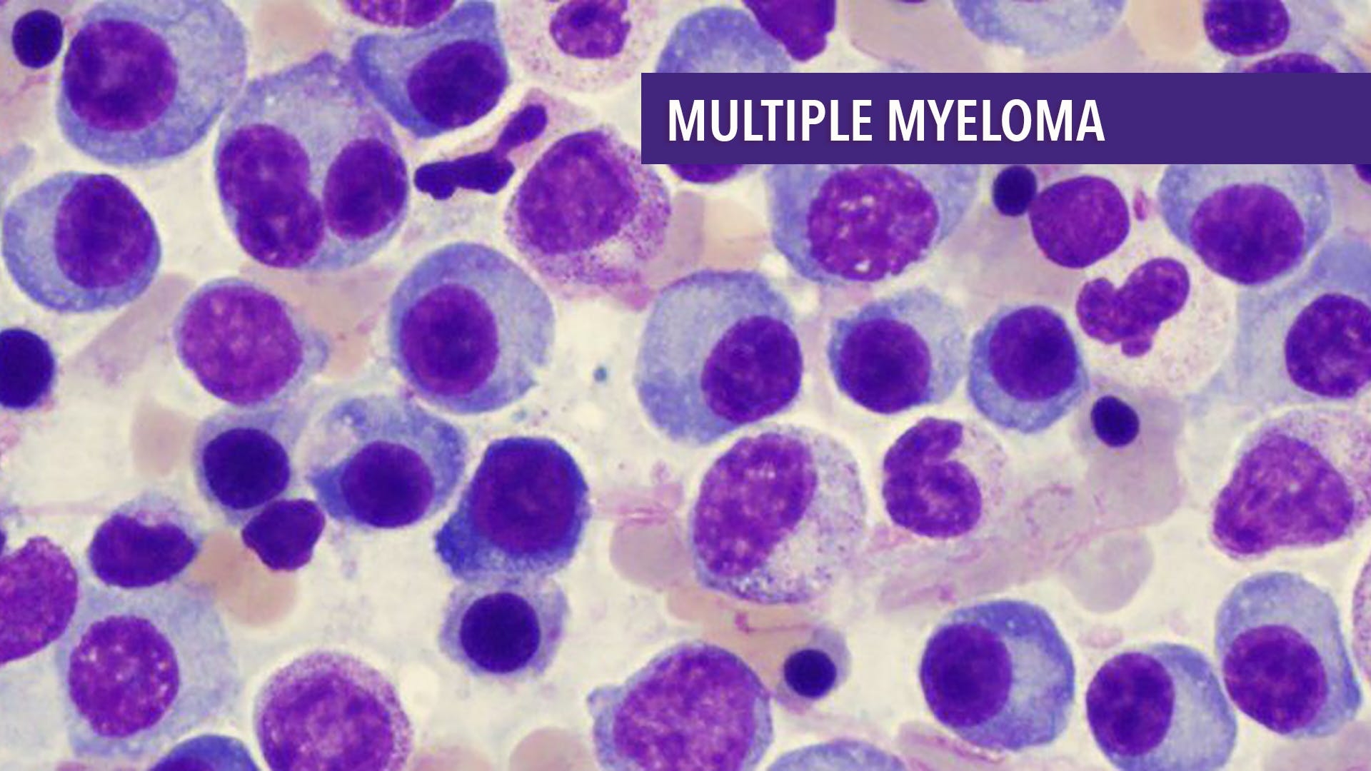 Multiple Myeloma: Symptoms, Causes, Diagnosis And Treatment | KnowInsiders