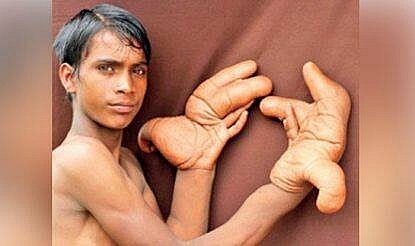 Only in India: Mysterious Condition of Boy with The Most Giant Hands in the World