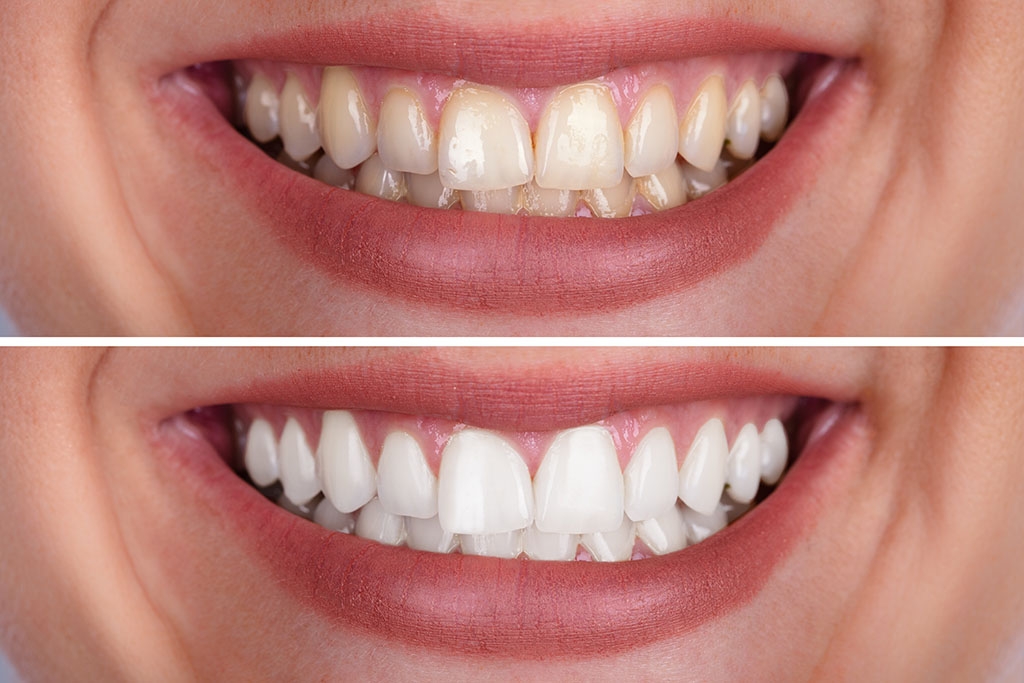 4955 how to remove teeth stains at home