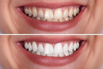 How To Remove Teeth Stains At Home