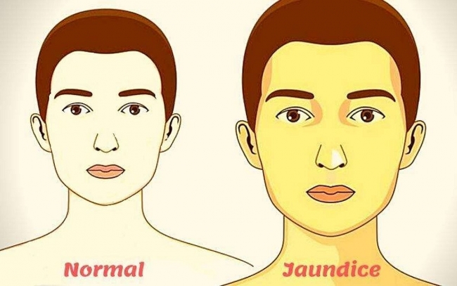 jaundice symptoms causes transmission treatments for a common diseases in india