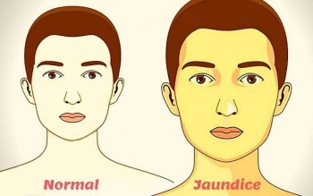 Jaundice: Symptoms, Causes, Transmission, Treatments for a Common Diseases in India