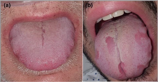 Facts about COVID Tongue: Peculiar virus Symptoms, Signs of Infection