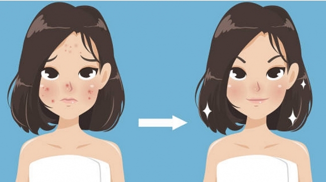 Best Tips to Avoid Acne for Teenage Girls