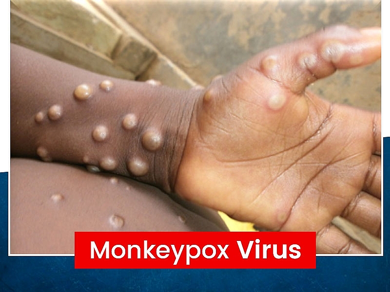 Find out the monkeypox cases around the world right now