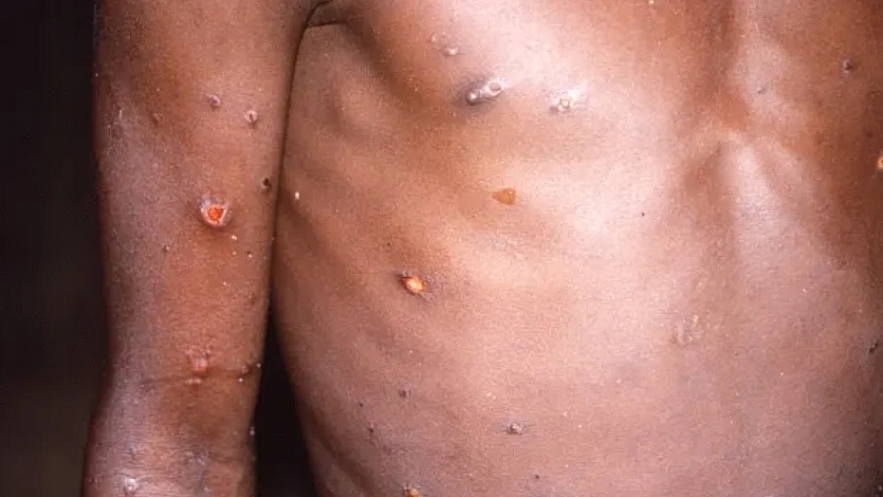 Facts About Monkeypox: Signs, Symptoms, Treatment and Causes