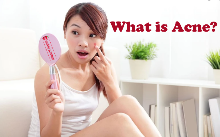 what is acne causes tips and treatment at home