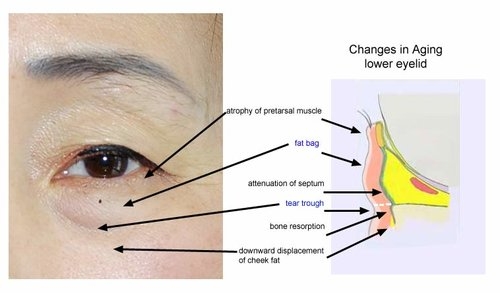 How to Reduce Bags Under Eyes